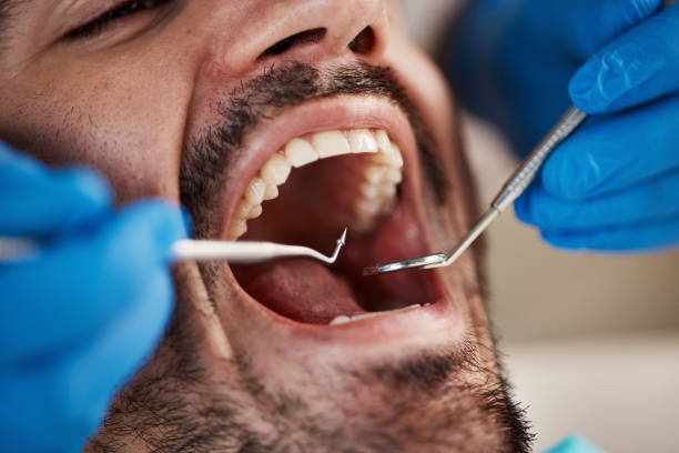Best Emergency Wisdom Teeth Removal in Madison, AL